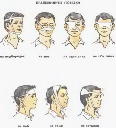 пращевидные пов'язки