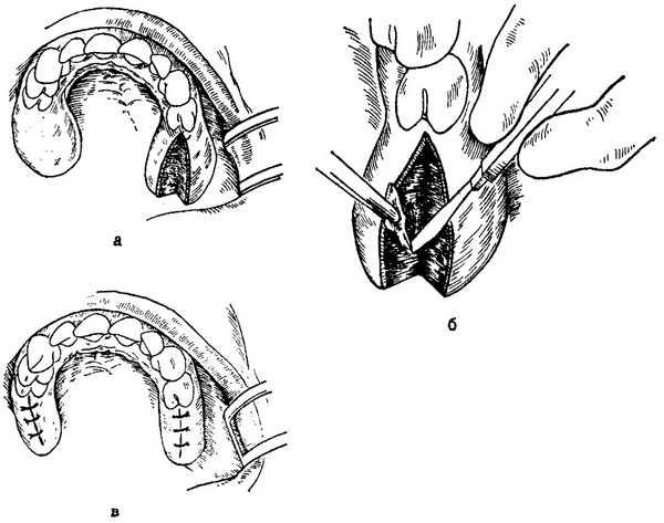схема операції з приводу симетричних фібром