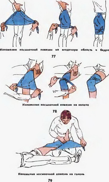 накладення косыночной пов'язки на сідничний область стегно коліно гомілка