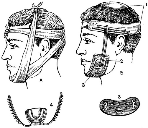 найпростіші методи іммобілізації фрагментів пошкодженої нижньої щелепи
