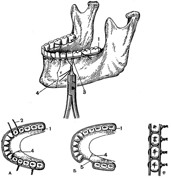 види дротяних шин