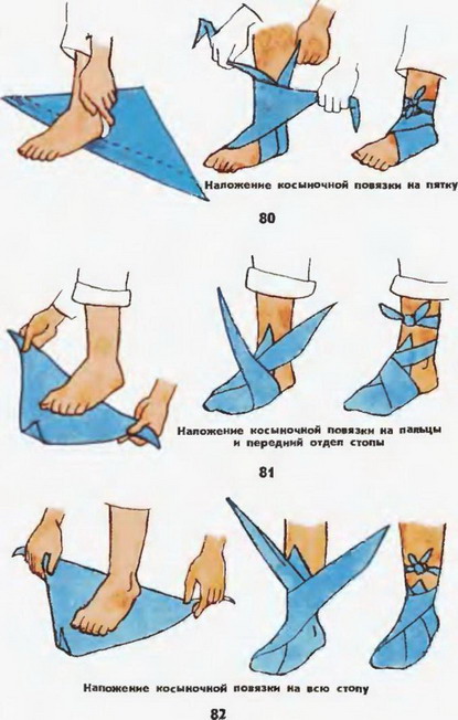 накладення косыночной пов'язки на п'яту і стопу