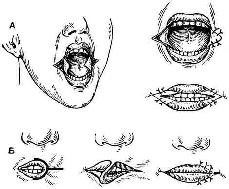 схеми операцій при мікростомії