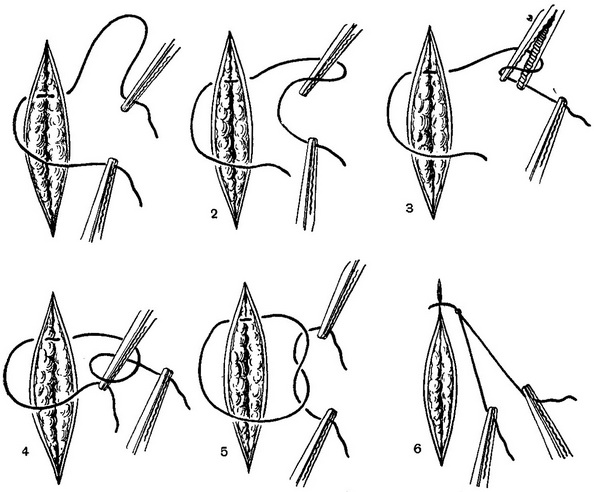 етапи виконання аподактильного шва
