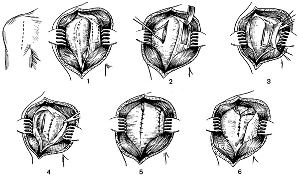 сухожильно-м'язова пластика двох зв'язок плечового суглоба по Башкірова - Сафонову