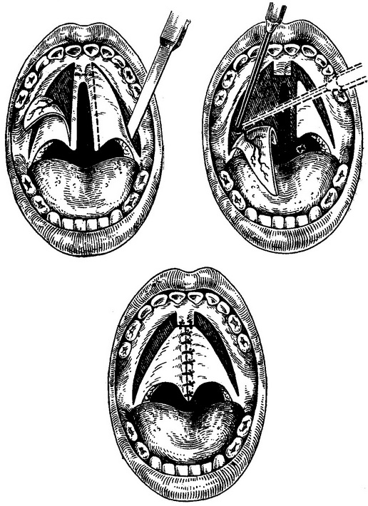 операція при ущелині піднебіння за Лімбергом