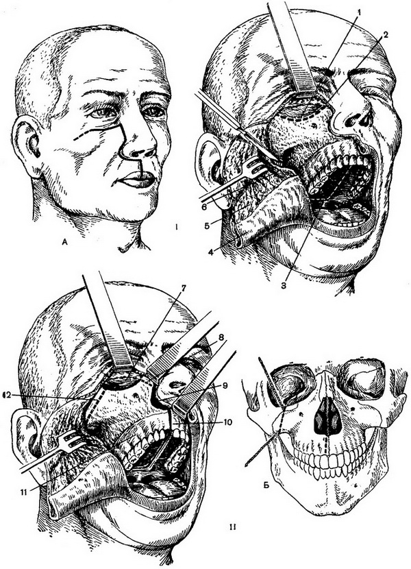 видалення правої верхньої щелепи