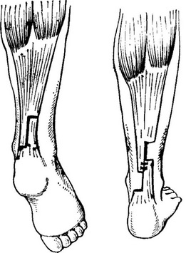 ахиллопластика