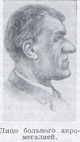 обличчя хворого акромегалію