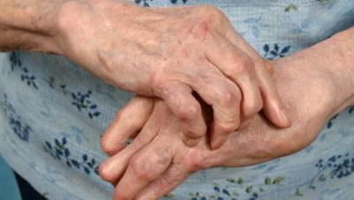 ревматичний артрит