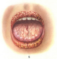 ексфоліативний хейліт