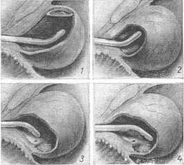 огляд наповненого сечового міхура