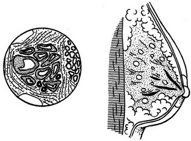 дольковий фіброаденоматоз