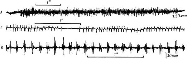 електроміограму