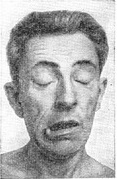 хореический гиперкинез