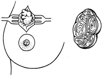фіброаденома