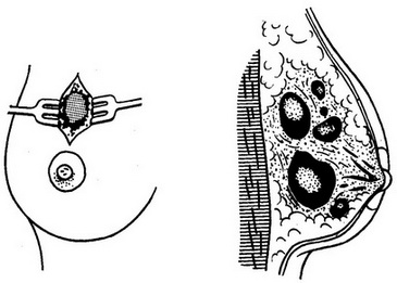 кістозний фіброаденоматоз