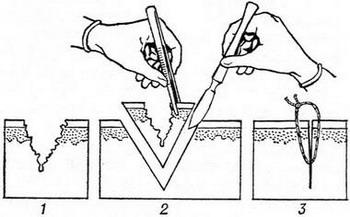 первинна хірургічна обробка рани