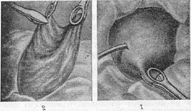 ovariotomy