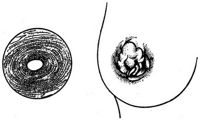 плазмоцитарный мастит