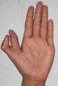 полідактилія