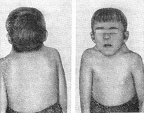 синдром Кліппеля-Фейля