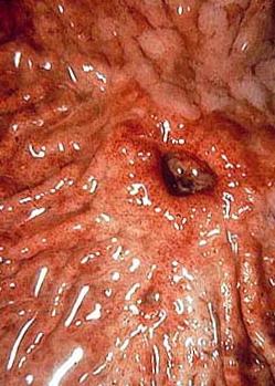 виразка шлунка