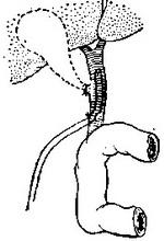 дренування загальної жовчної протоки